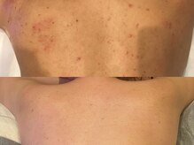 ルース 白河店(LUZ)/背中ニキビ症例写真