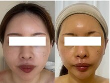 ４か月間、月に一度のWISHproと当店オリジナルの施術効果です