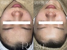 リツ(Ritsu)/ニキビケア/ざらつき