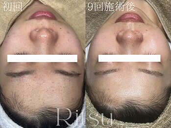 リツ(Ritsu)/ニキビケア/ざらつき