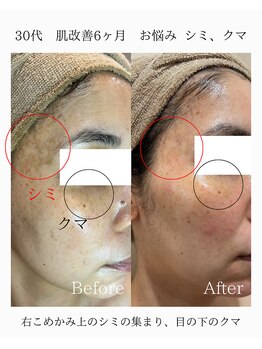 由縁/シミ改善プログラム