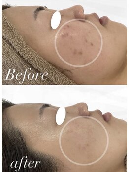 ミセル(MISEL2nd)/ニキビケア/肌質改善もお任せ♪