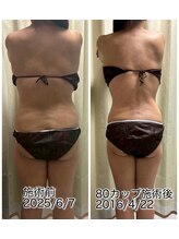 クールスパ(COOL SPA)/50代女性 背中症例