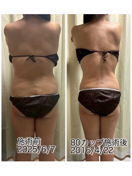 クールスパ(COOL SPA)/50代女性 背中症例