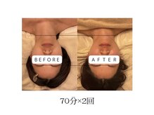 ファミーユ 豊橋店/【術後ケア】クマ取り術後ケア