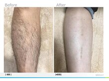 モーイエンチャーム(mooi en charme)/足脱毛