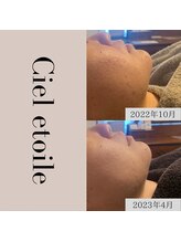 シエルエトワレ/【ニキビ特化】改善コース