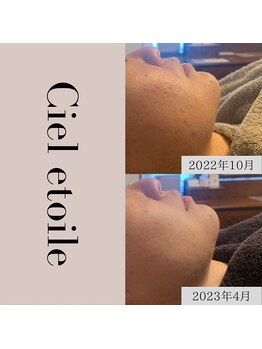 シエルエトワレ/【ニキビ特化】改善コース