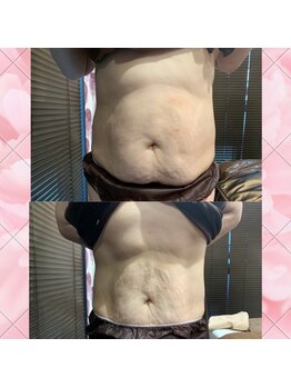 グレースフル 薬院店(greaceful)/リバウンドなし脂肪冷却マシン！