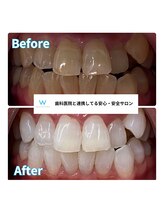 ホワイトニングショップ 甲府店/ホワイトニングの効果