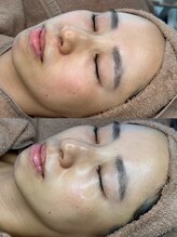 ユーイン 塩尻店(U-in)/ララピールビフォーアフター