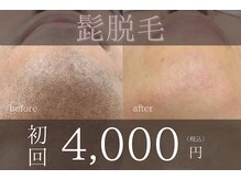 ジュブリーの雰囲気（髭脱毛）