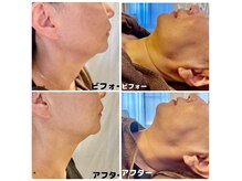 たるみによる老け顔にお悩みの方はレモンボトル