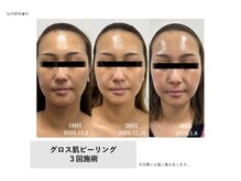 トータルクリア(TOTAL CLEAR)/Gloss肌ピーリング