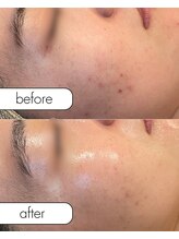 アール(R;)/2回でニキビが出来にくくなる