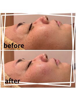 エステティックサロンフランジパニ(frangipani)/肌質改善◎シミ、小ジワケアに♪