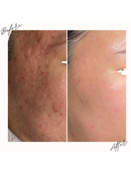 イチロクイチハチ(1618)/ニキビケア赤みには