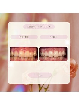 プラスビーセルフ(+b self)/ホワイトニングビフォーアフター
