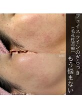 アウラプラス(Aura+)/毛孔性苔癬改善症例