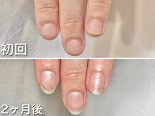 グラシュータン(gracieux temps)/【深爪矯正13000円】