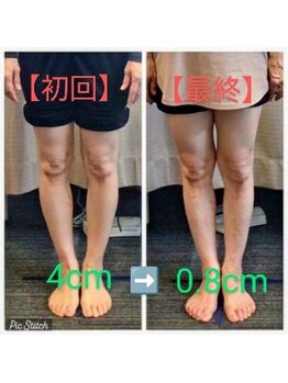 クシロ鍼灸整骨院/【O脚矯正】施術例