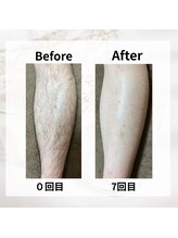 サロン ルイ(salonRui)/足脱毛　before　afuta