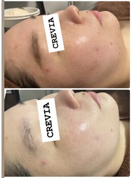 クレビア(CREVIA)/最新光フォトビフォー・アフター