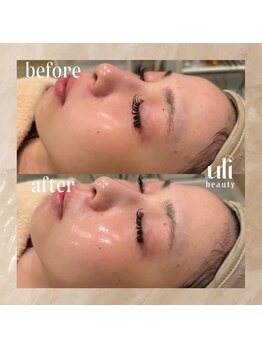 ウリ(uli beauty)/比較写真