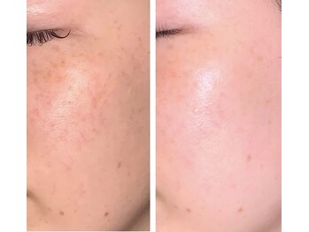 エシャーム(echarme)/Eライト 光フェイシャル