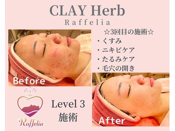 ラフェリア 弘明寺(Raffelia)/★クレイハーブピーリング★