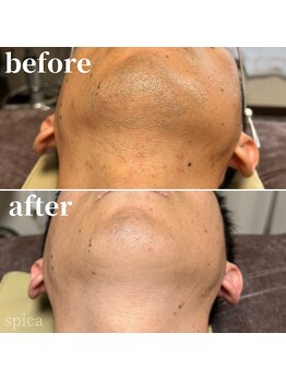 スピカ(Spica)/ヒゲ脱毛で朝の5分を解消!!