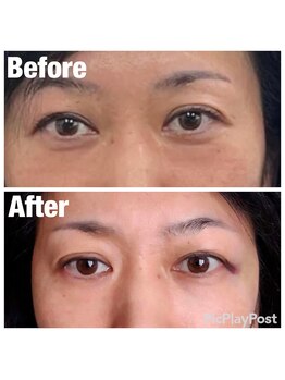 くじら整体院 鍼灸院/目元のしわ、たるみ、クマ