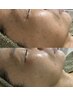 【美肌応援】ハーブピーリング+圧倒的エイジングケア 60分 