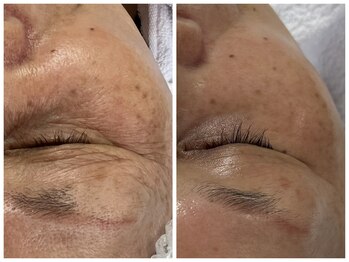 フェリス(FELIZ)/シワにはレチノールフェイシャル