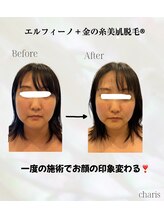 カリス(charis)/一度の施術で圧倒的小顔☆