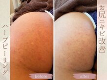 ラナ(LaNa)/お尻ケアにもハーブピーリング◎