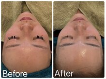 サロンドフェイス(Salon de Faith)/ハーブピーリング3回