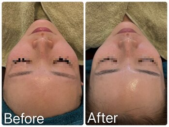 サロンドフェイス(Salon de Faith)/ハーブピーリング3回