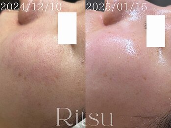 リツ(Ritsu)/メラニン毛穴/毛穴/美白
