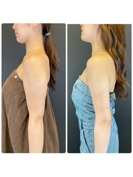 エステアンドヘアーサロン アルテ 札幌/辛い二の腕の術後はアルテに