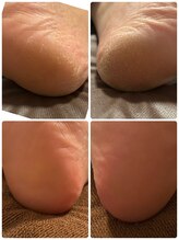 パッチ バイ サロンデヤンス(Patch by SALON DE YANSU)/かかと角質ケア♪