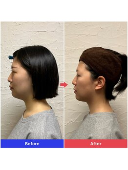 整音(totonone)/口ゴボ・Eライン・二重アゴ