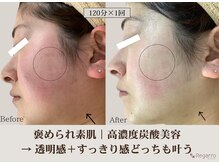 レガロビューティクリエイションズ桜川店/高濃度炭酸肌改善フェイシャル