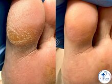 プラスワンフット 本厚木(+1 Foot)/タコ・魚の目ケア！痛みから解放