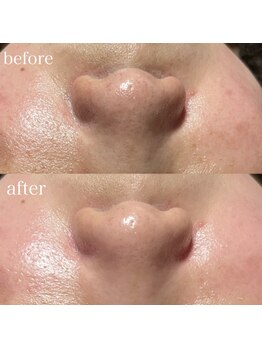 薫風/毛穴洗浄/20代