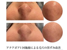 ピービー(PB)/毛穴洗浄