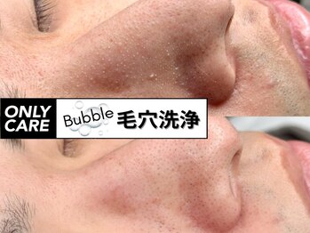 オンリィ ケア(ONLY CARE)の写真/《メンズの肌に特化したサロン》噂のBubble毛穴洗浄が出来る!小鼻の皮脂を特殊な溶剤で浮かして優しく吸引!