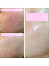 ガーデン(Garden)&nbsp;ハーブ 施術工程