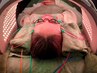 【しわ改善/肌理の整った艶肌に】エクソソーム美容鍼+LED 75分 ¥13000