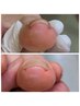 【巻き爪】巻き爪補正1ヵ所 (箇所で料金変動)+下処理セット